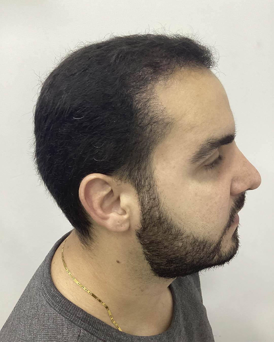 Caso 16 - Depois
